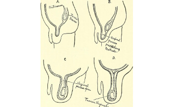Testis undescended